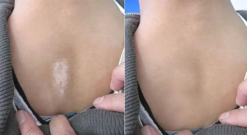 产后为什么会出现白斑？准妈妈哺乳期得了白癜风怎么办？