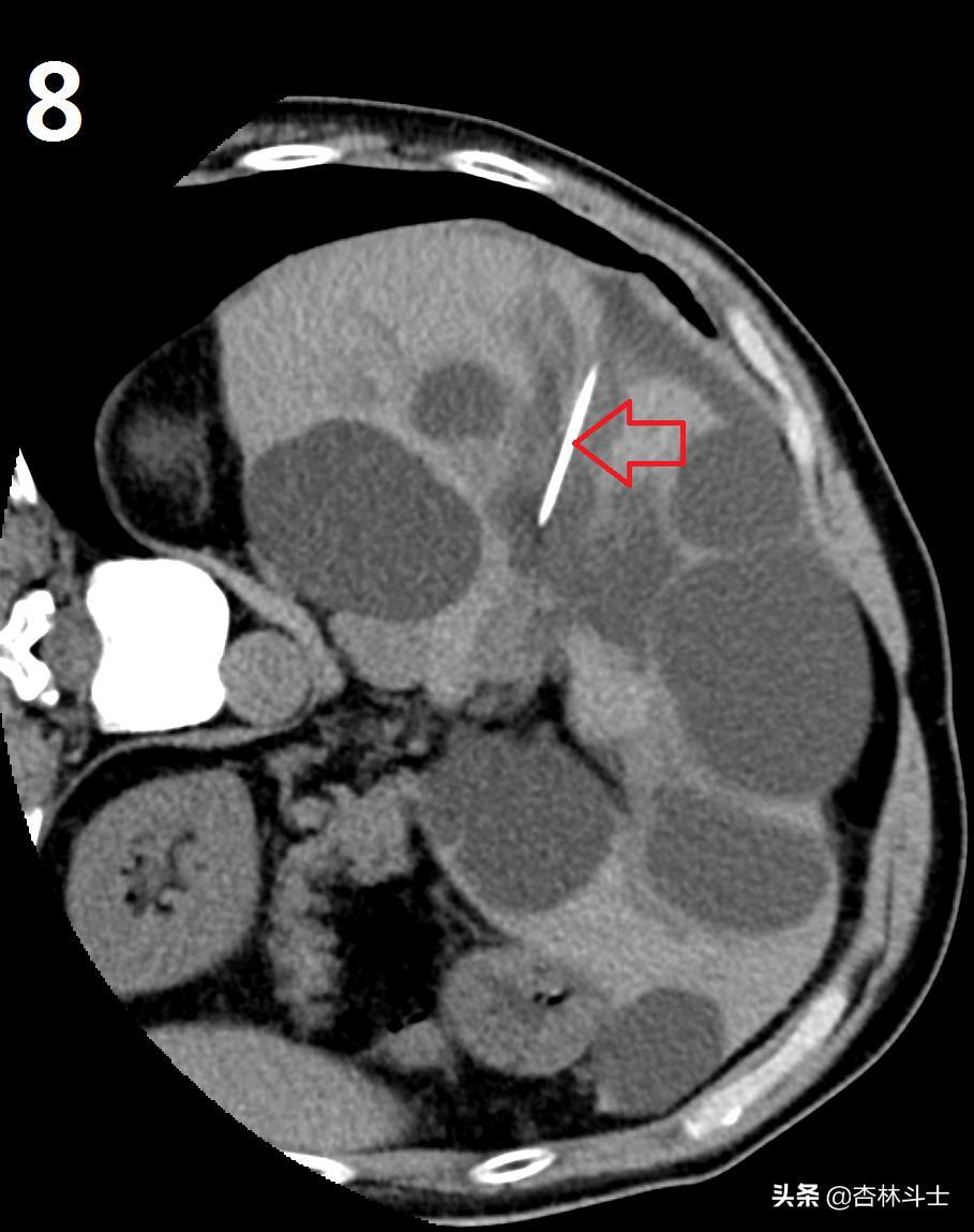 64岁银行职员患肝囊肿，CT引导下细针穿刺抽吸酒精硬化解决大问题