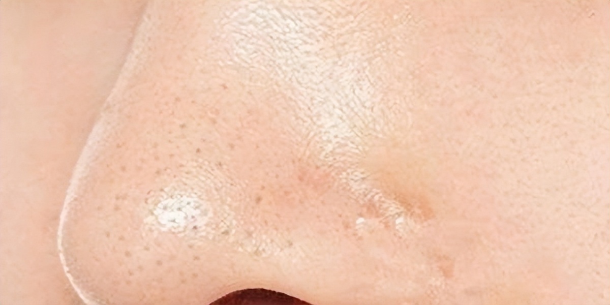 清理毛孔堵塞疏通神器,毛囊堵塞怎么疏通毛孔