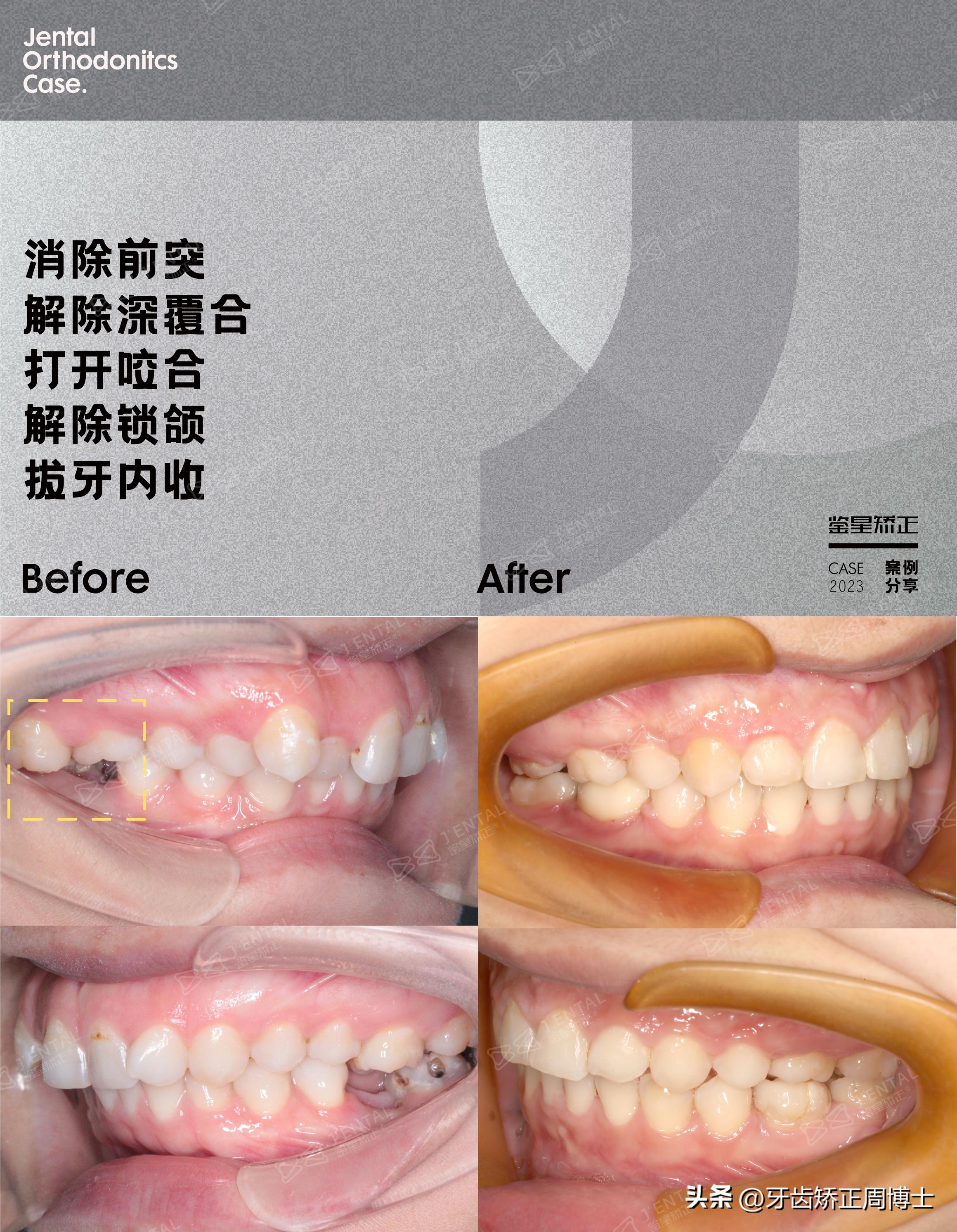 轻度拥挤龅牙咬合错位,龅牙导致牙齿咬合错位矫正价格