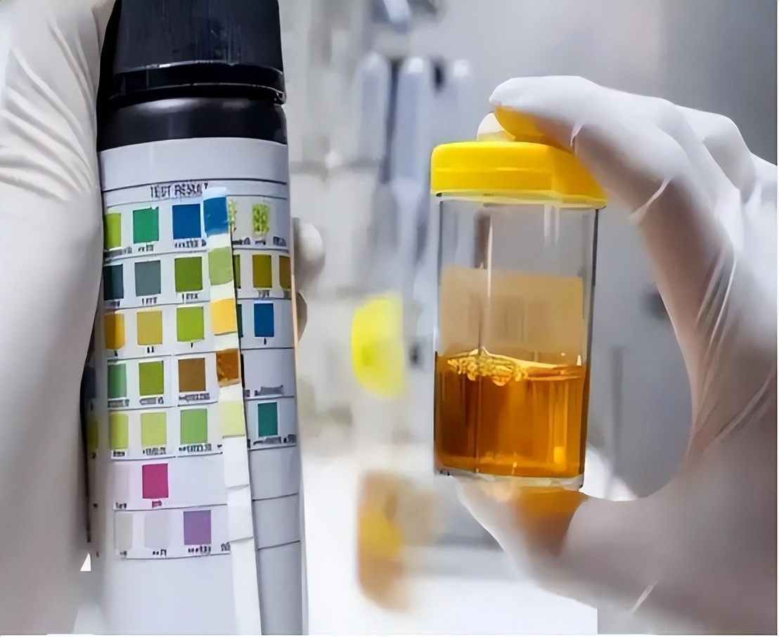 排尿很黄、异味很大？身体向你暗示的这5件事，可能与疾病有关