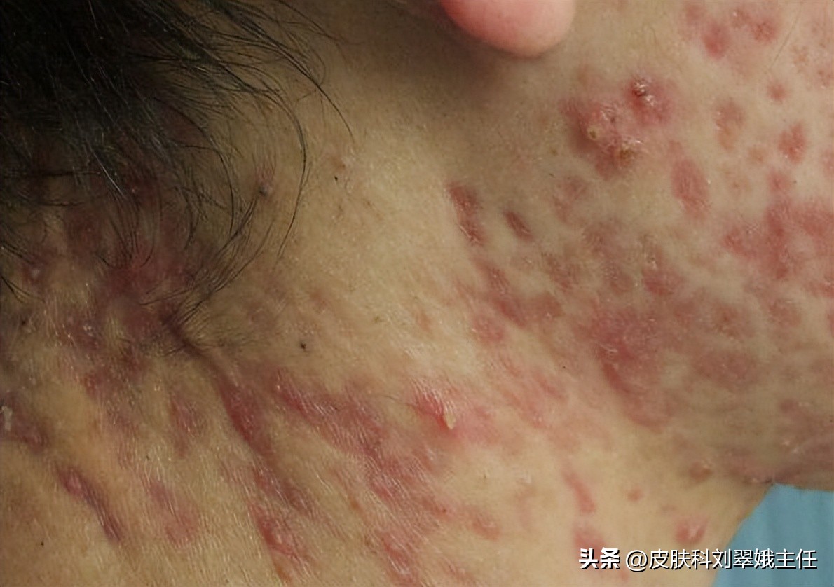 穿掘性毛囊炎什么导致的,穿掘性毛囊炎什么原因造成