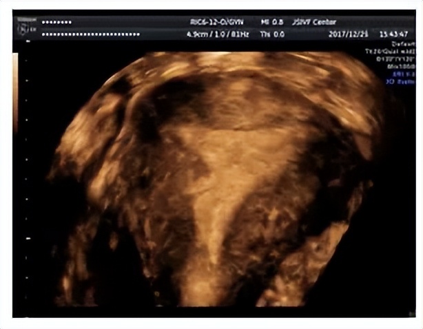 宫腔粘连影响生育吗?要怎么处理?