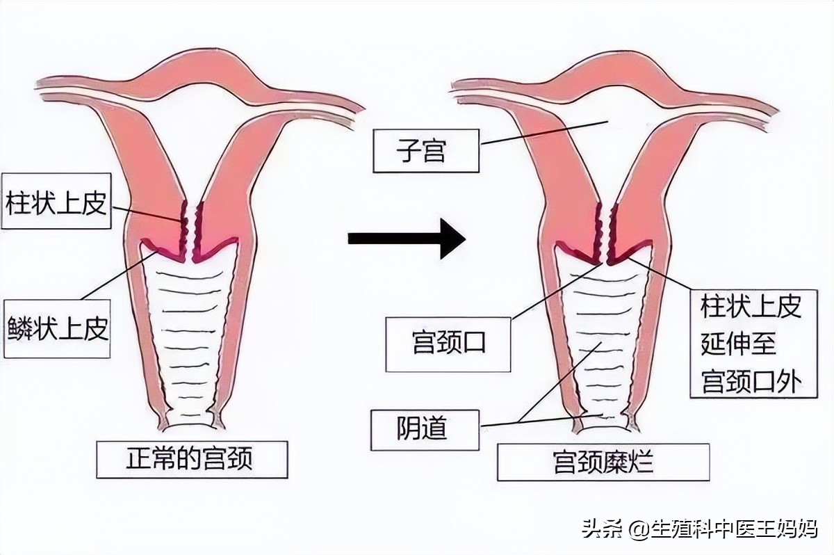 女子被切掉子宫,宫颈糜烂癌变是不是都要切除子宫