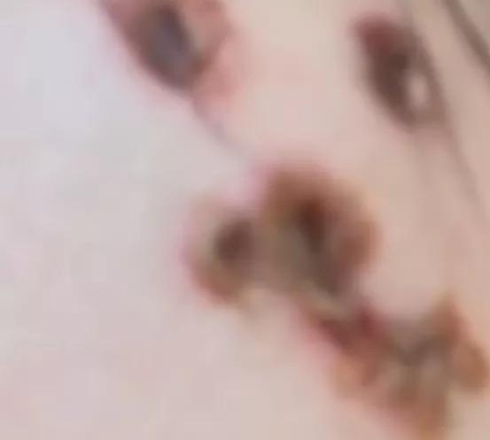 药水点痣烧伤,用药水点痣后留下的红疤怎么去除