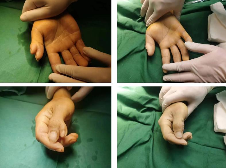 真人蟹钳型六指手术全过程,六指蟹钳切除手术哪家医院靠谱