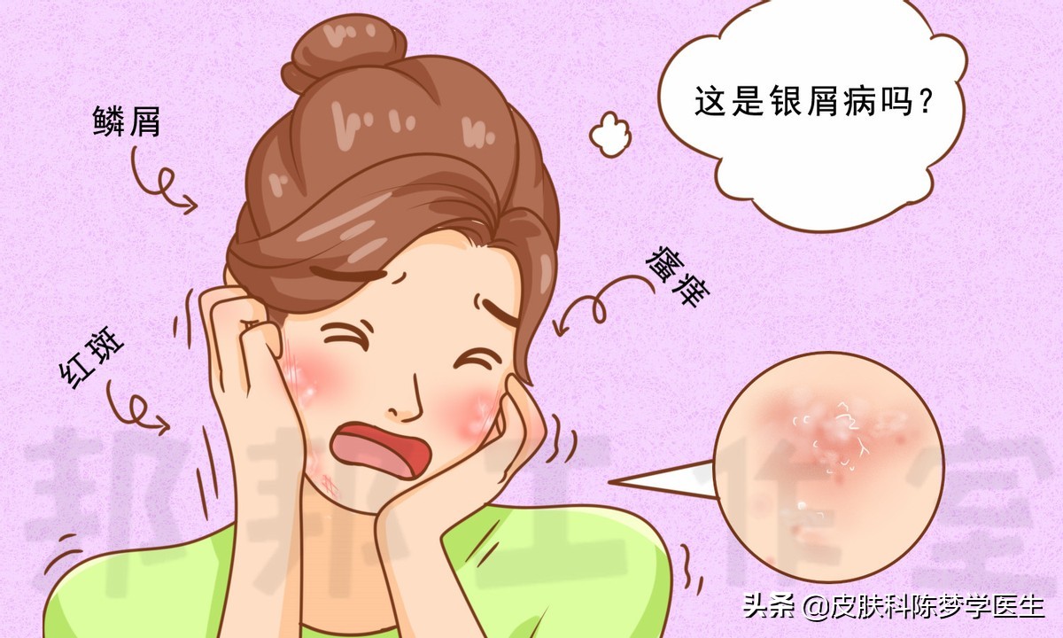 脸上出红斑一定是红斑狼疮吗,脸上长鳞屑红斑性皮疹