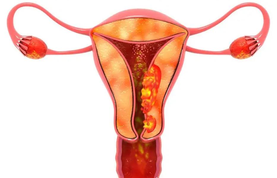 女子确诊宫颈癌，子宫全切！提醒：身体这3处异常变化，别再忽视