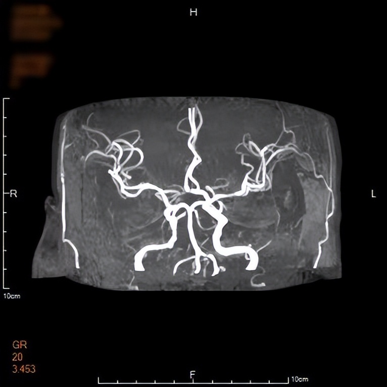 河北保定:市第一中心医院成功救治一例罕见的“心形”脑梗死患者