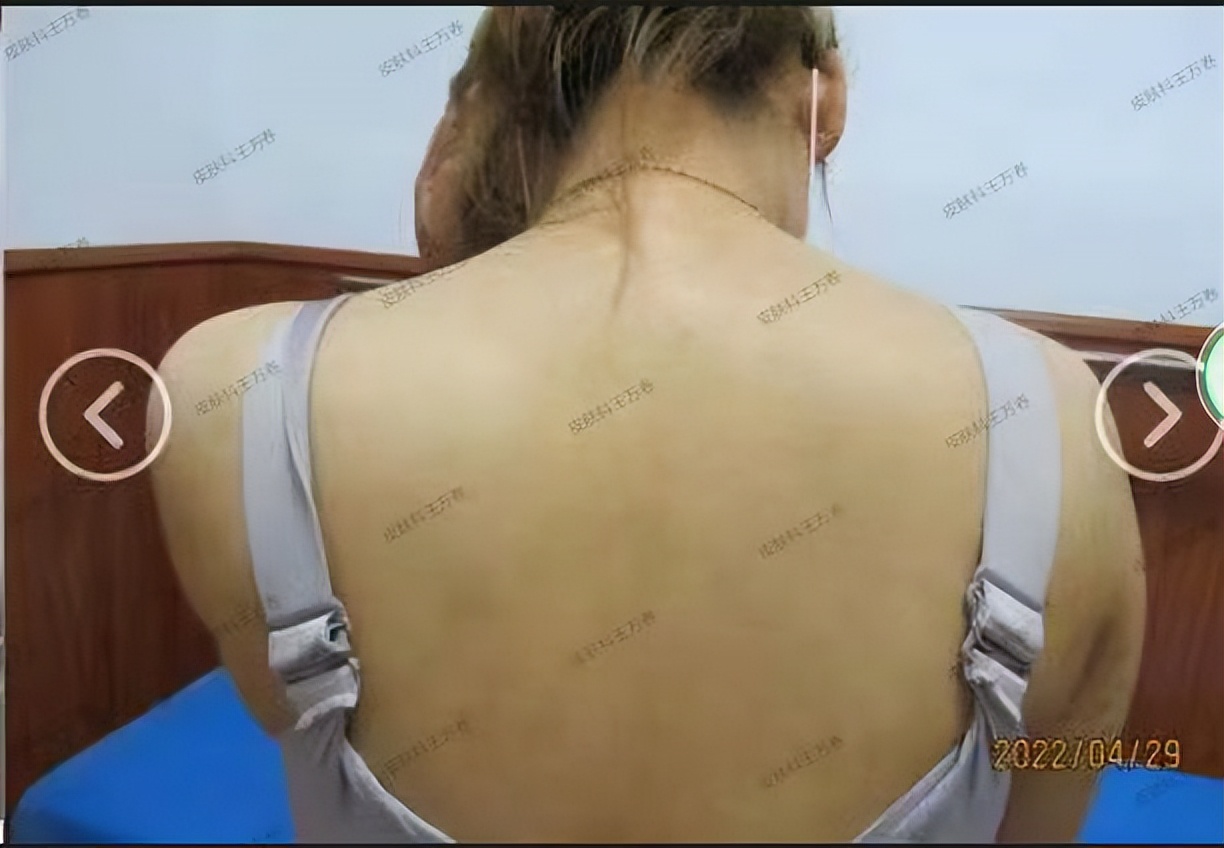 银屑病怎么治疗彻底最有效的方法,银屑病怎么治疗彻底最有效