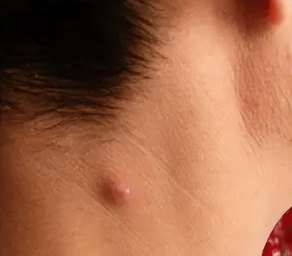 皮肤表面的小肉球是什么,皮肤上的小疙瘩小肉球