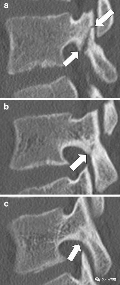 峡部裂和隐性峡部裂有区别吗,单纯峡部裂可以做峡部修复吗