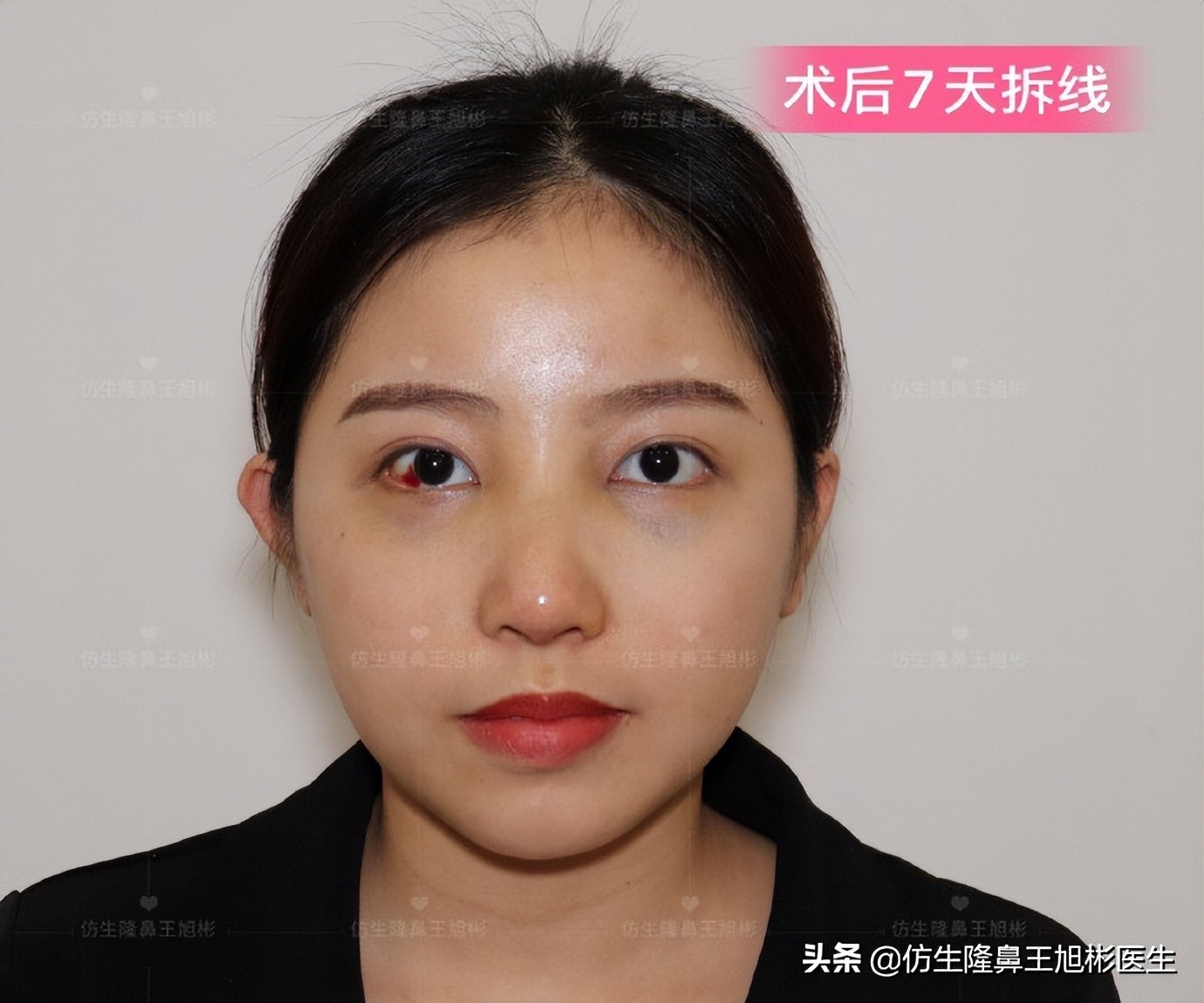 手术鼻头增厚能用什么方法弄,大鼻头高鼻梁缩小手术案例