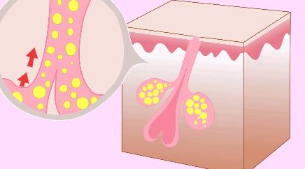 孕期祛痘能用哪些药膏,孕期长痘痘用什么面膜正确