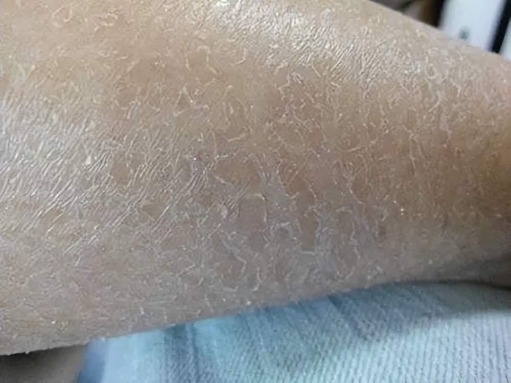 洗完澡身上痒还起皮是怎么回事,洗完澡皮肤干燥起皮浑身痒