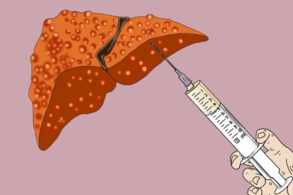 钇90微球抗癌新药价格,钇90治疗肝癌最新价格