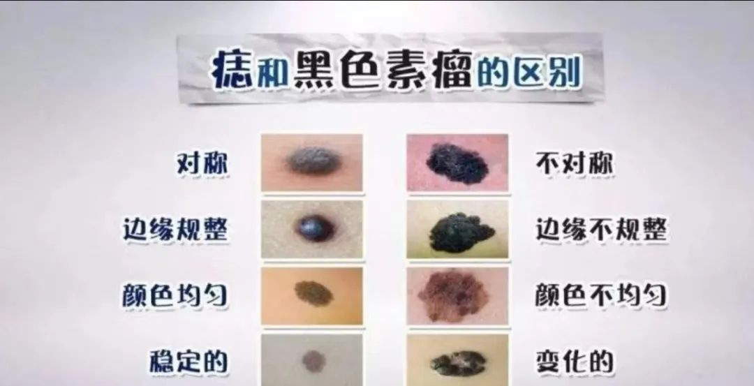 什么样子的痣需要警惕,身上有这种痣要警惕了