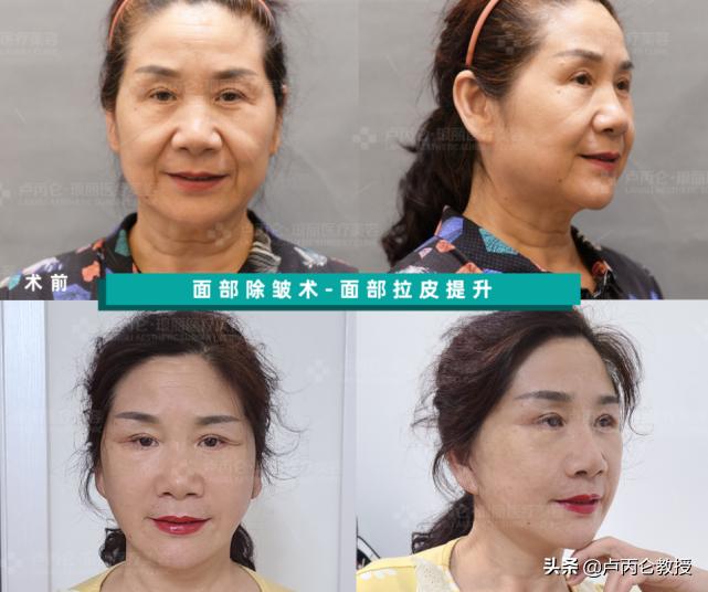 做拉皮除皱手术后遗症,拉皮除皱手术有哪些风险和后遗症