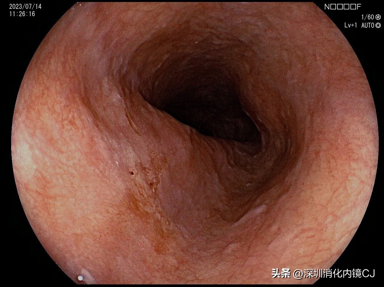 69岁及时发现食管癌，内镜下微创根治，避免了外科开胸手术
