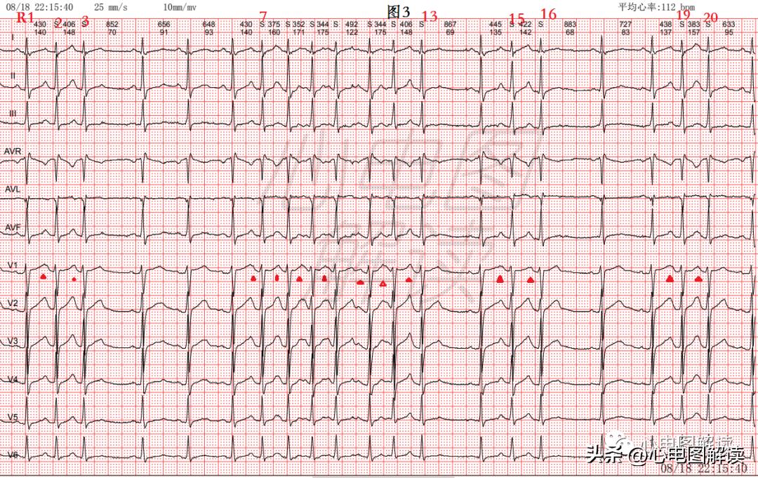 房早室早区别,房早室早房颤
