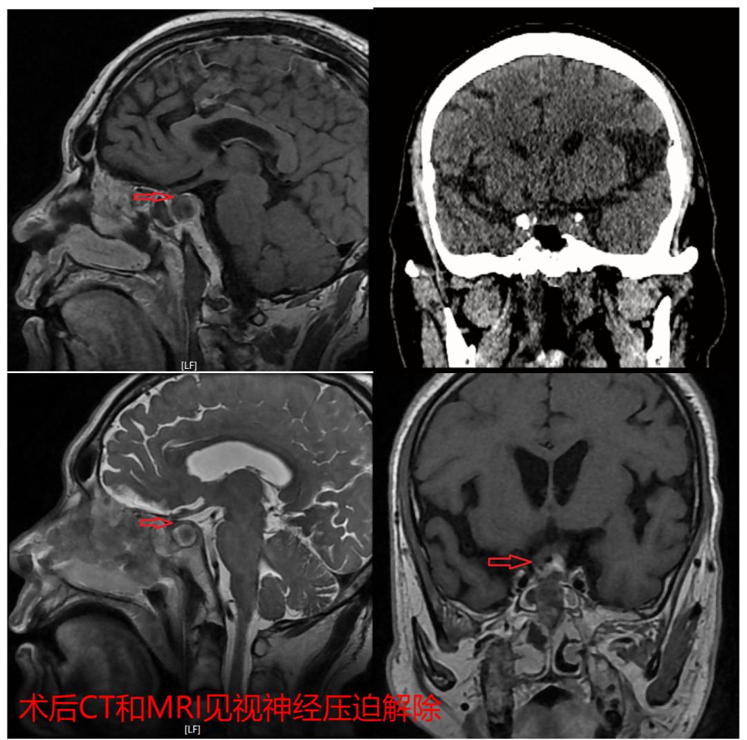 抢救失去的光明——市中心医院神经外科急症切除脑垂体瘤卒中一例