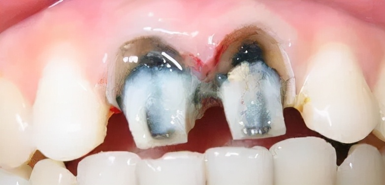 为什么牙医不愿意给我做烤瓷牙套,为什么牙医不想给病人做单冠