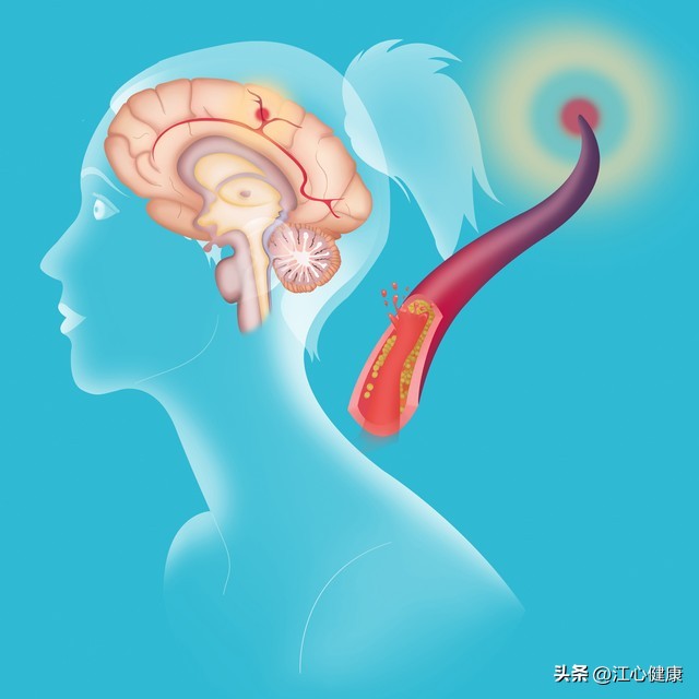 脑梗后为什么会得帕金森综合症,帕金森属于脑梗后遗症么