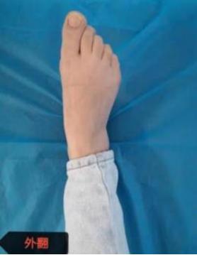 足踝骨折康复,足踝骨折康复训练视频