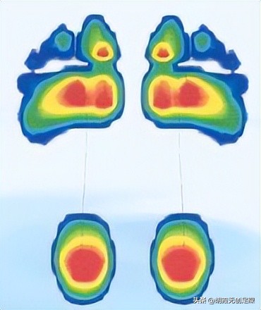 高弓足外翻怎么治疗,高弓足与扁平足哪种易治疗