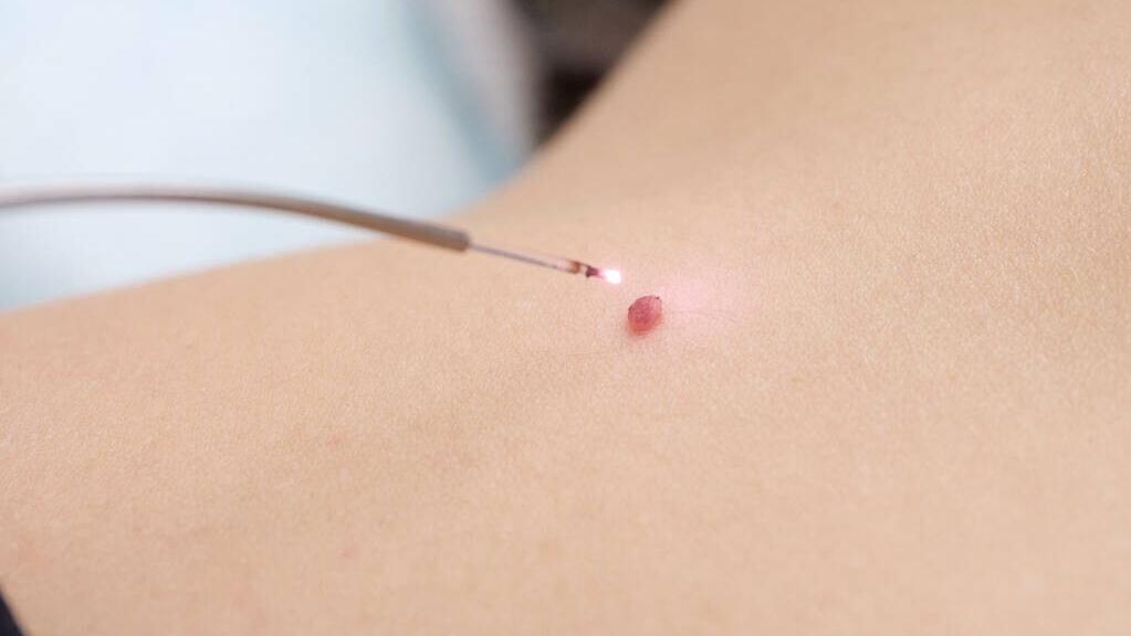 寻常疣扁平疣和跖疣,寻常疣与扁平疣哪个严重