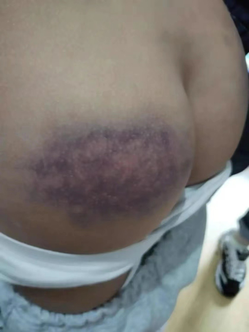 小孩被老师打的淤青如何维权,幼儿小朋友被老师打淤青