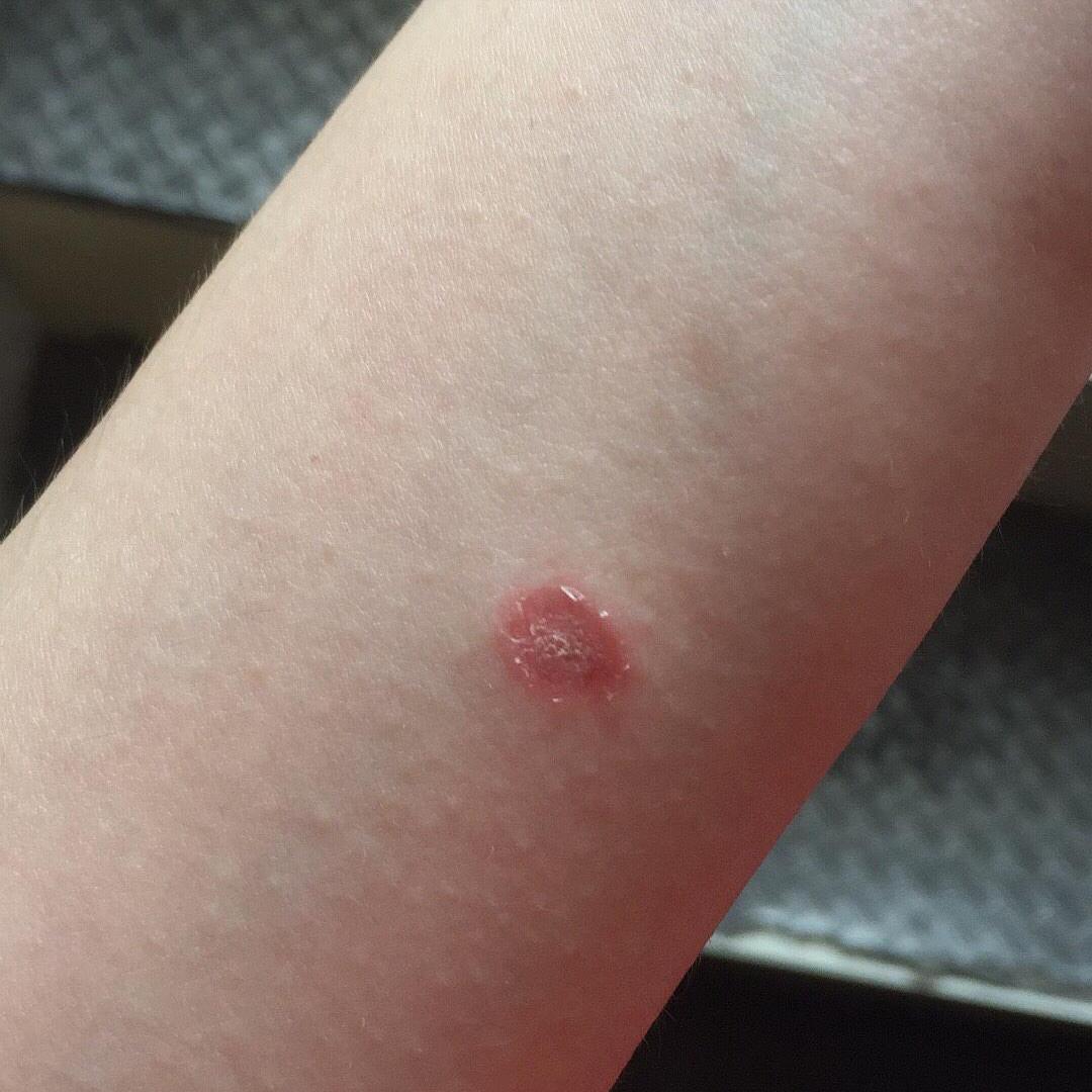 猫得了猫癣还会再得猫癣吗,猫癣是怎么形成的猫癣有什么症状