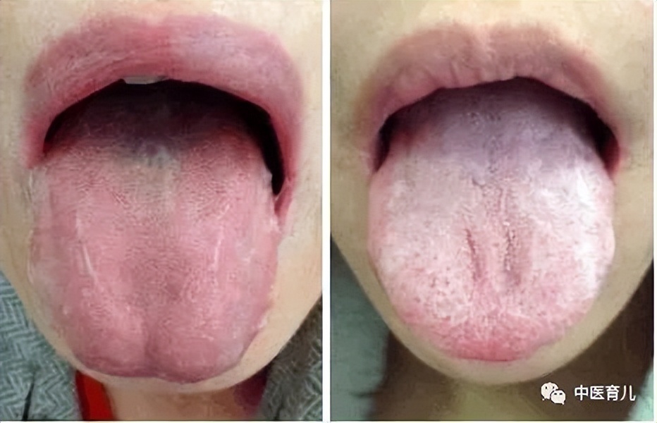 怎么区分孩子是寒咳还是热咳,寒咳和热咳怎么区分看舌头