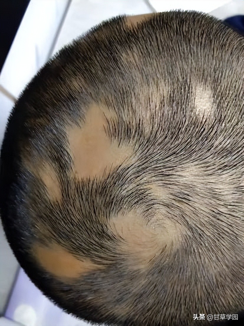 复方甘草治疗斑秃,甘草煮水治疗斑秃效果好吗