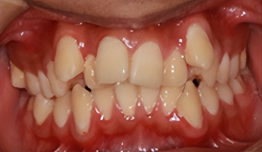 拔牙矫正后多长时间能合缝,拔牙矫正需要缝线吗