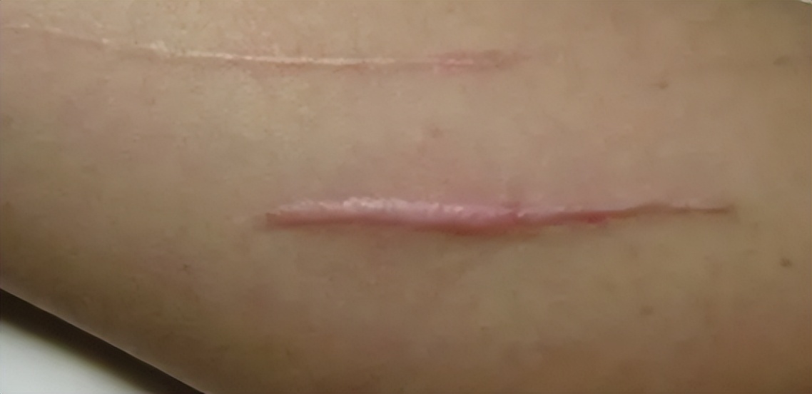 疤痕膏哪种效果最好,效果好的疤痕膏有哪些