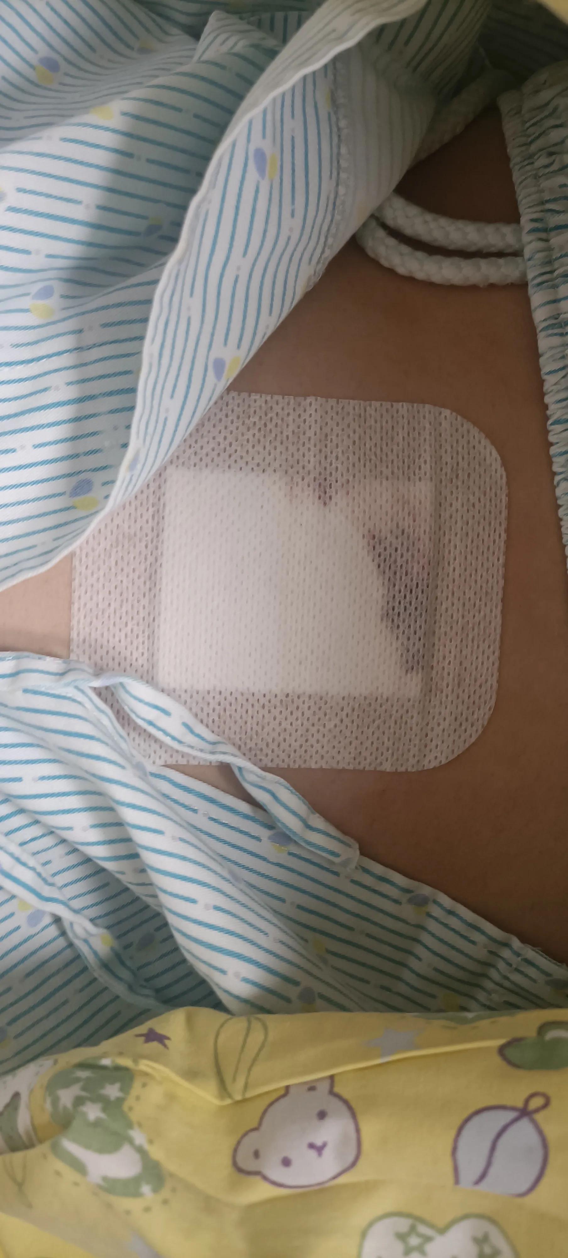 阑尾炎微创手术出院后注意事项,阑尾炎手术术前护理