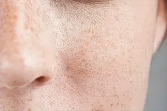 老年斑和色素沉着怎么治,老年人色素沉着怎么去除