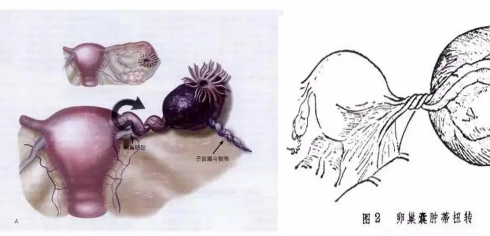 10岁女孩连续腹痛三个多月到医院,11岁女童腹痛晕厥