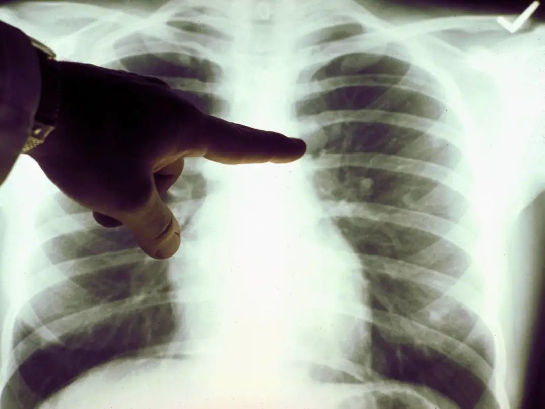 医生如何区别肺腺癌和肺鳞癌,医患同防注意哪些方面