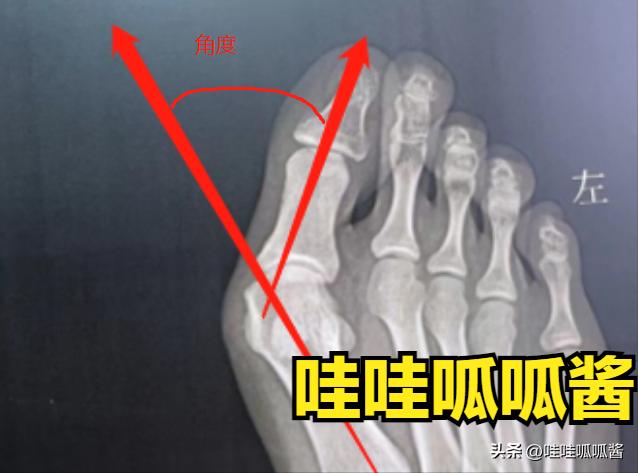 如果发现脚趾头歪了怎么办,脚趾歪了会变严重吗