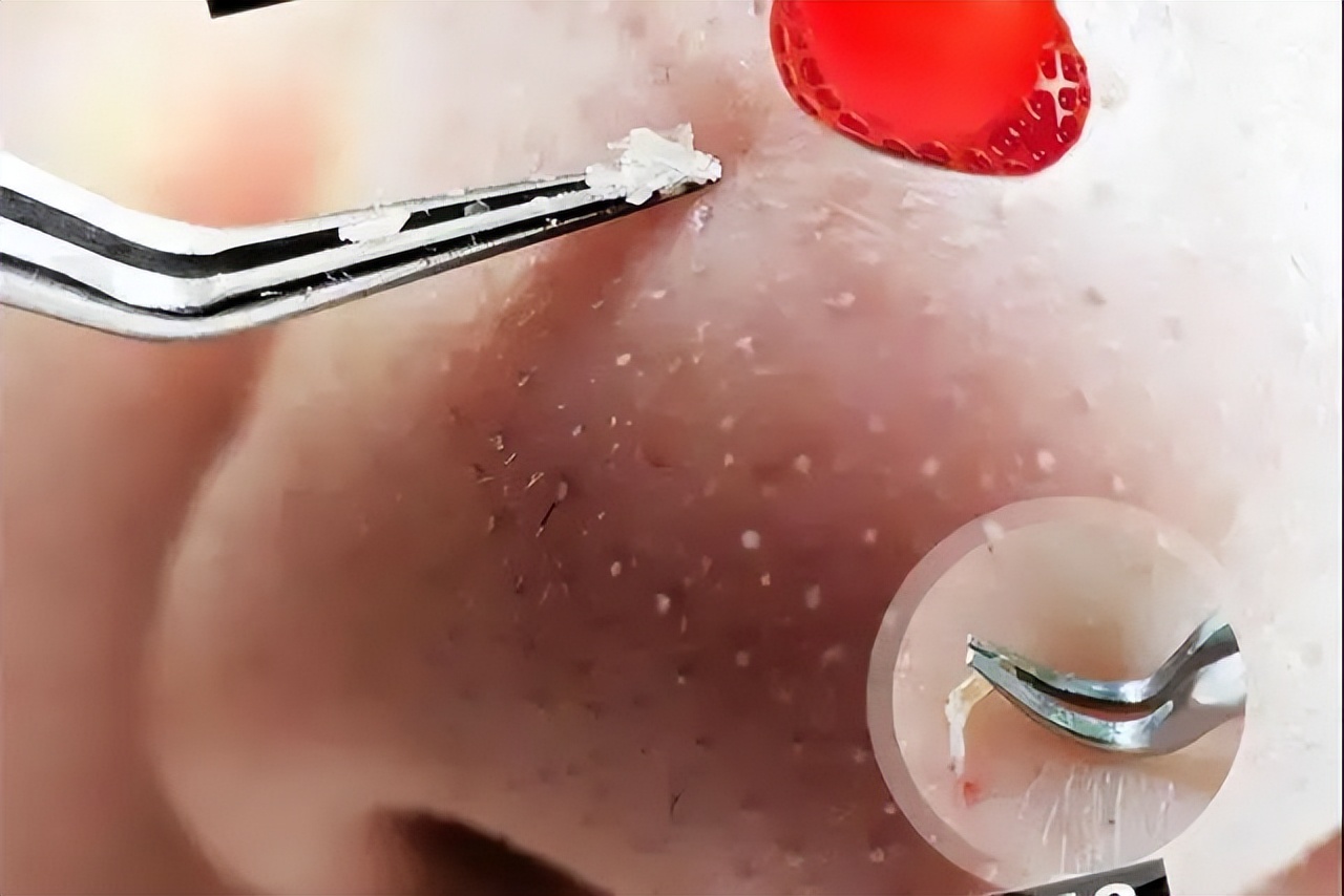 清洁面膜可以去黑头粉刺闭口吗,清洁面膜可以去除黑头吗