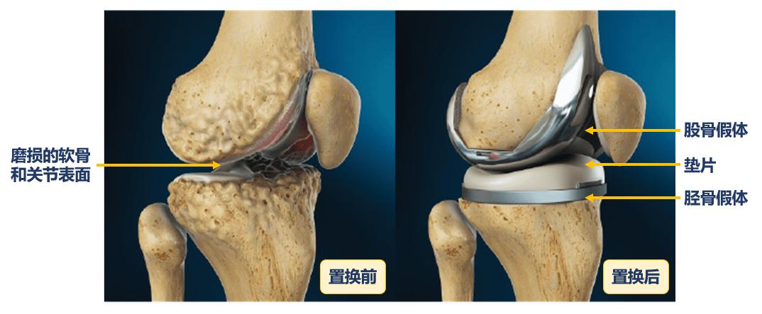 通过实例带你了解膝关节置换手术,医生为什么建议做全膝关节置换术