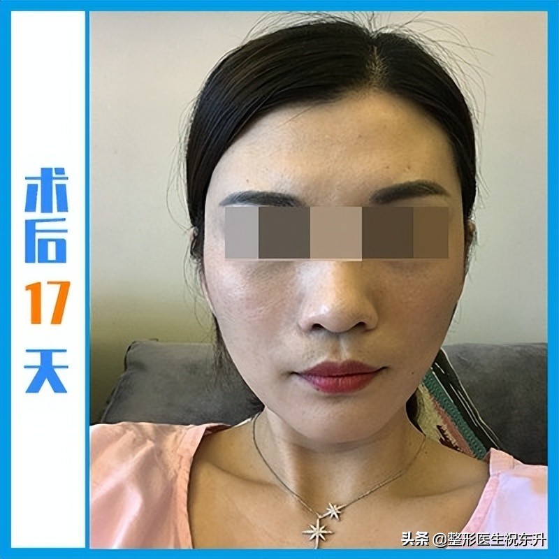 拉皮手术面诊,华西拉皮手术面诊后多长时间手术