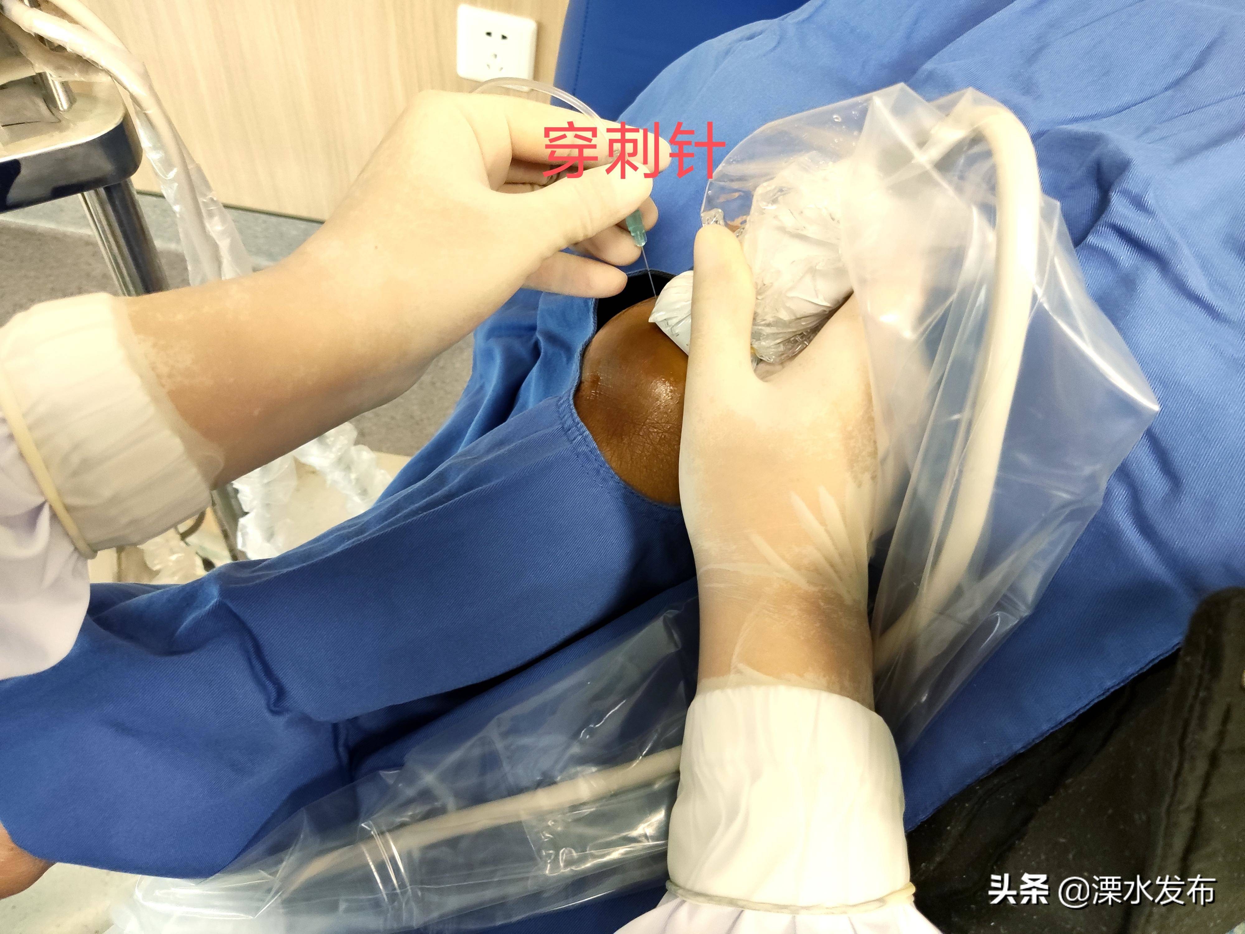 超声引导下假性动脉瘤介入治疗,动脉瘤封堵