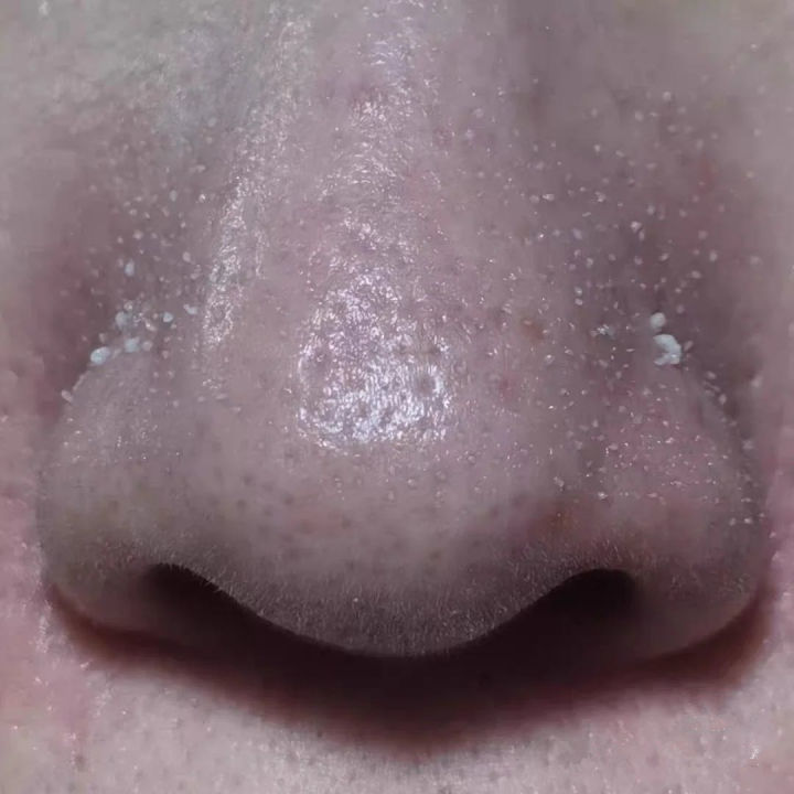 20年的黑头有多大,世界上最长的黑头到底有多长