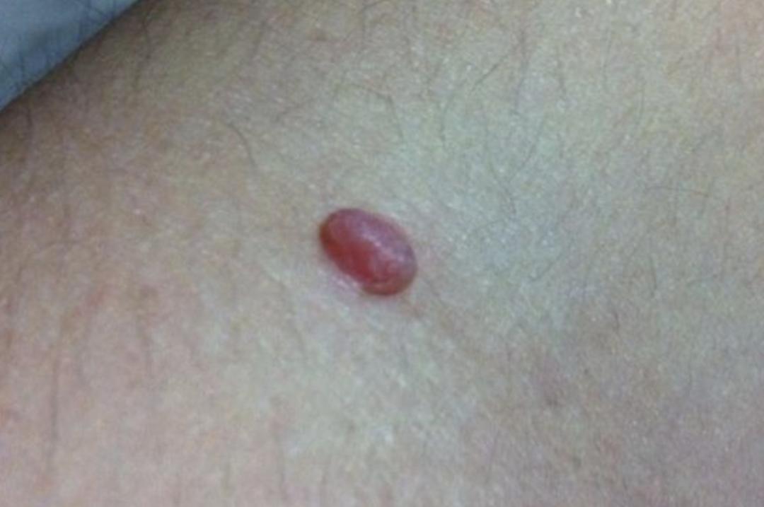 皮肤长小肉疙瘩可能是这3种类型,皮肤上的小肉球是疣吗