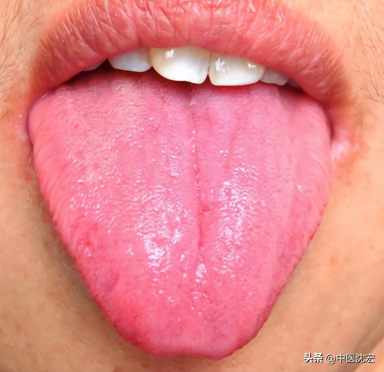 舌红舌头胖,舌暗红但舌苔很白是寒是热