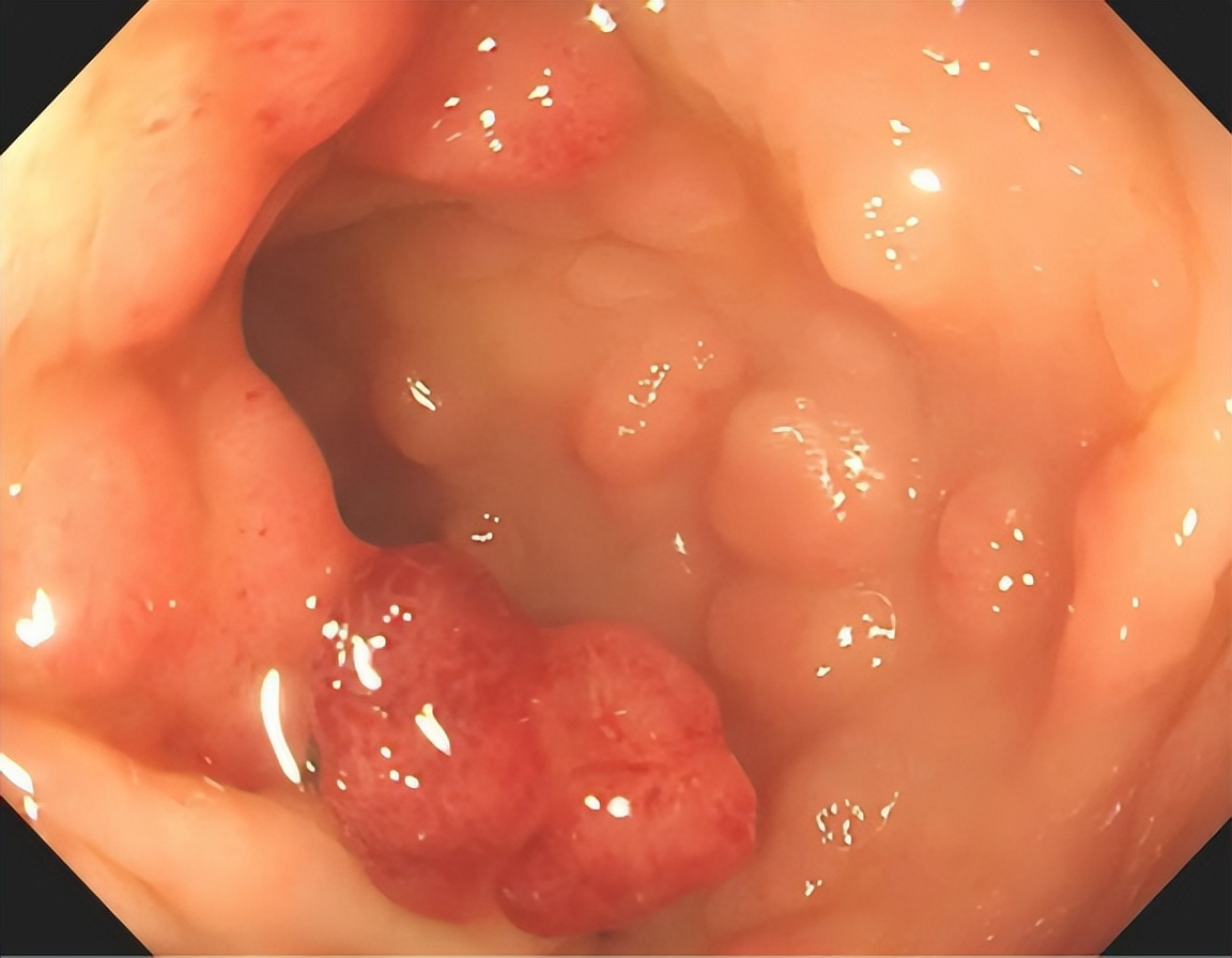 胃肠镜检查发现息肉会直接切除吗,肠镜检查中发现息肉咋办