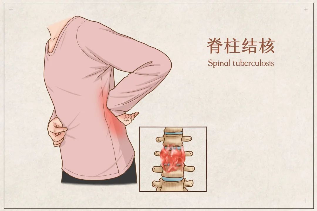 世界防治结核病日知识题库,世界防治结核病日科普